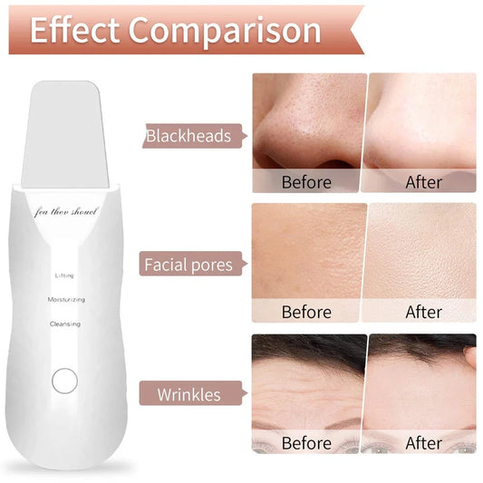 ⚡ Espátula Eléctrica de Limpieza – Peeling y Cuidado Iónico